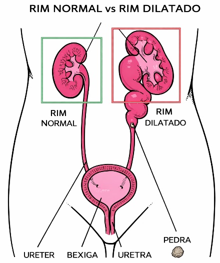Dilatação de um rim por obstrução provocada por um cálculo renal no ureter